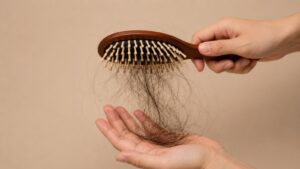 Foto de uma escova de cabelo com cabelo, representando a queda de cabelo